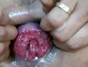 Vietnam anal prolapse together with fuck